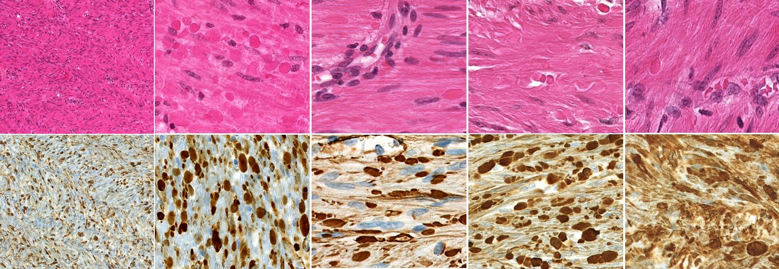 ACTG2 immunohistochemistry panel