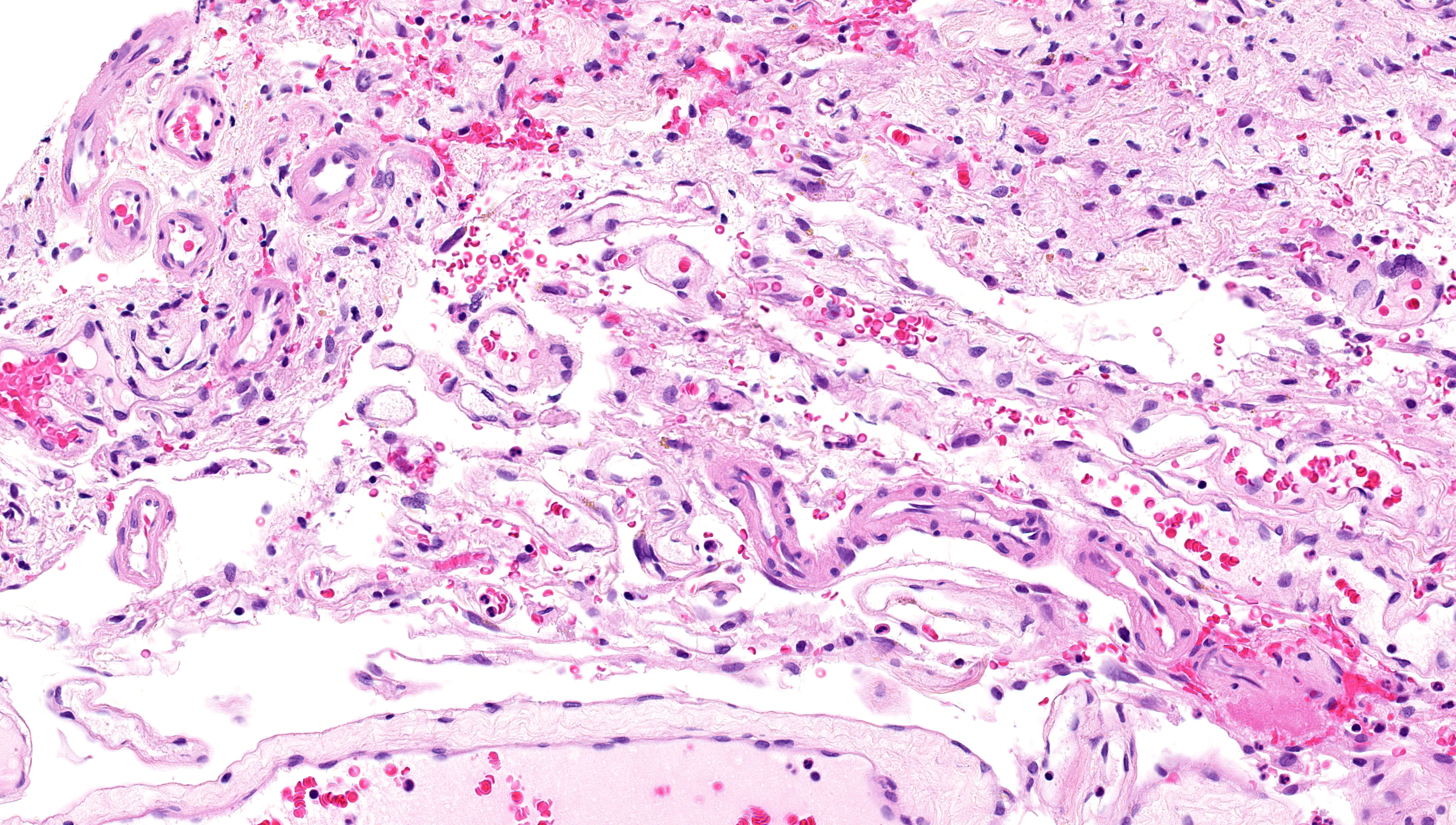Histology of leptomeningeal angiomatosis showing enlarged veins