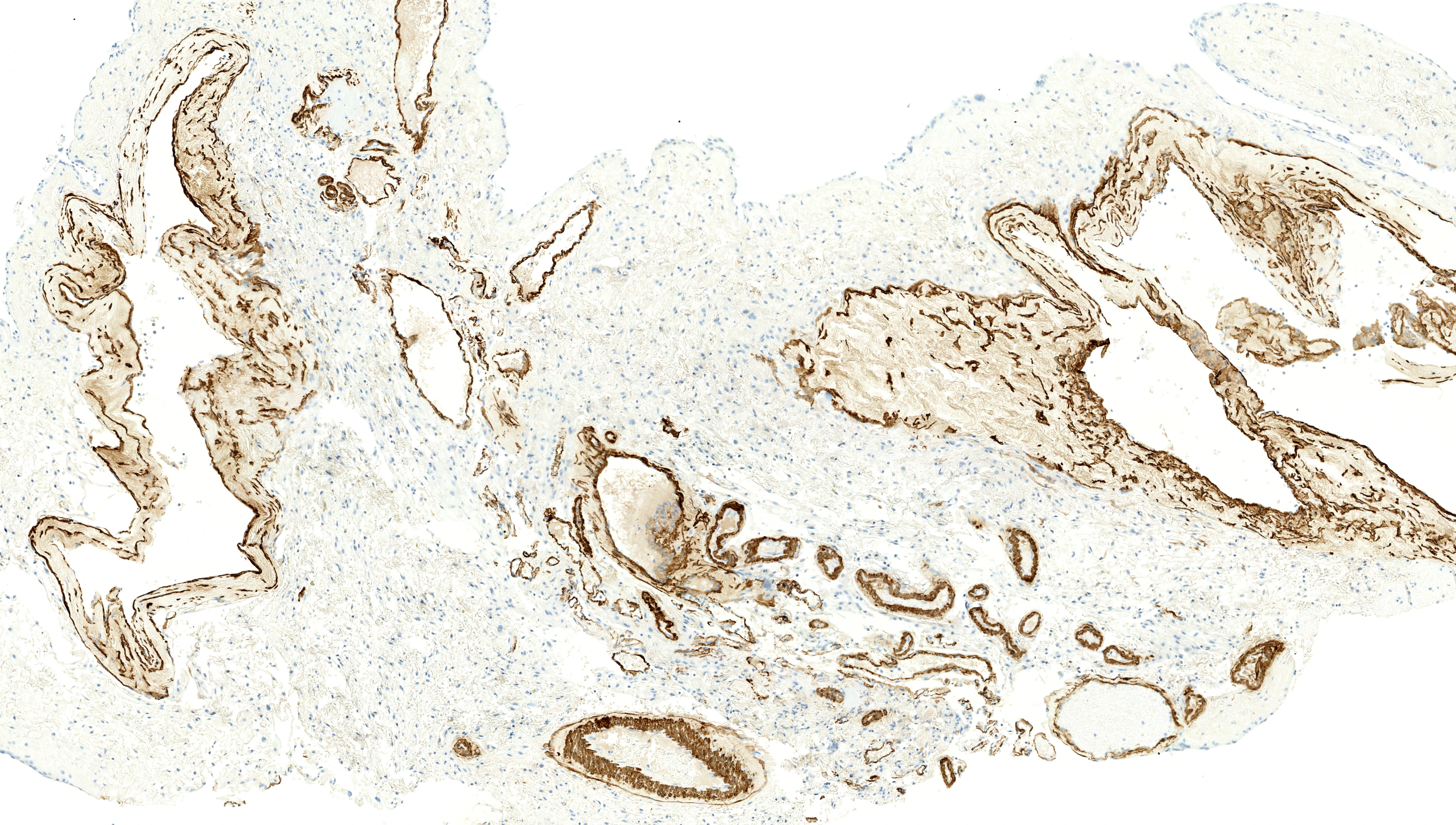 Immunohistochemistry showing alpha-smooth muscle actin in vein wall