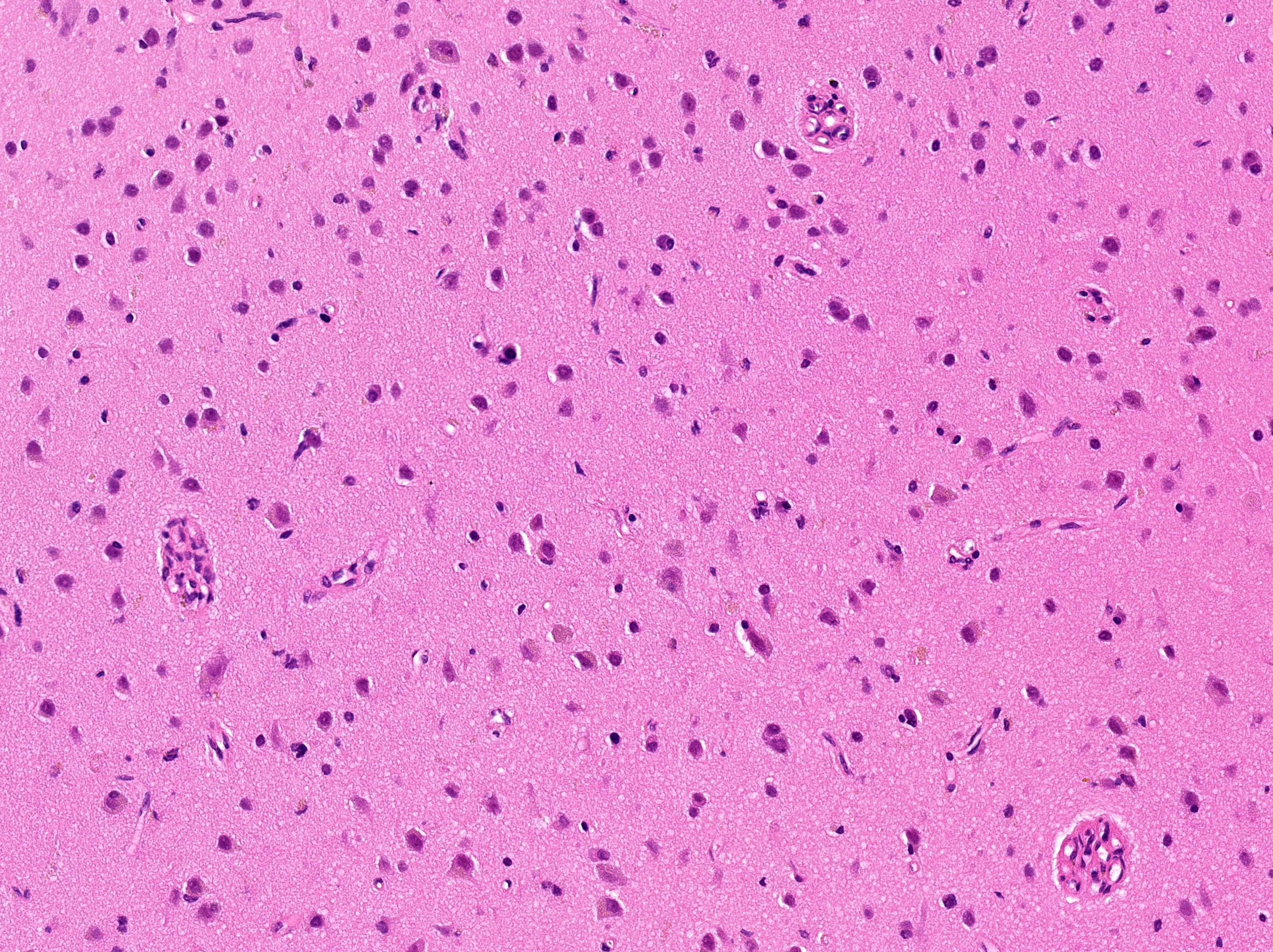 Glomeruloid vessels in cortical layers II-III