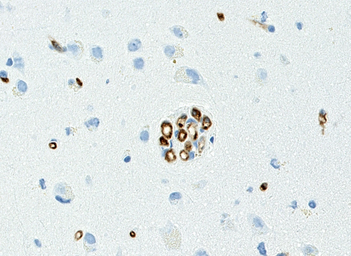 CD34 immunostaining of glomeruloid cortical vessels
